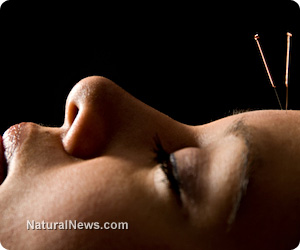 Acupuncture