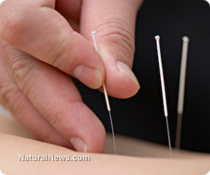 Acupuncture