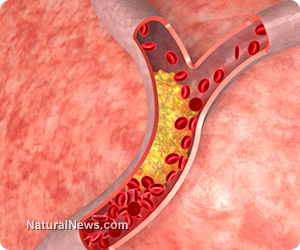 Coronary artery disease