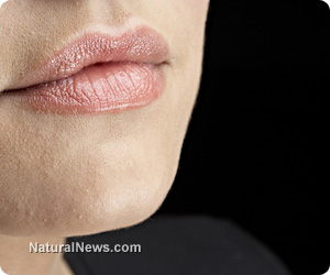 Chapped lips