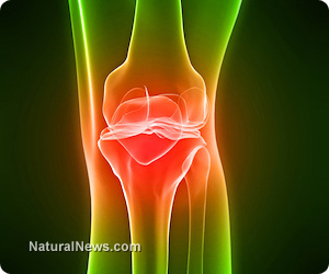 Arthritis treatment