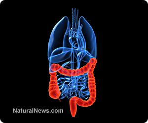 Colon cancer