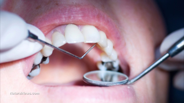 Mercury fillings