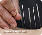 Acupuncture