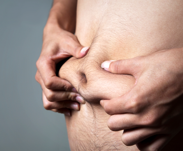 Fat-Overweight-Obese-Belly