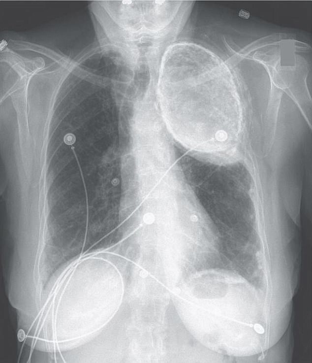 Image: SHOCKING: Woman’s x-ray reveals a pool of cooking oil in her lung