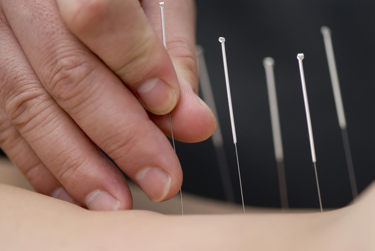 Image: Acupuncture found to promote weight loss by boosting appetite-suppressing hormones