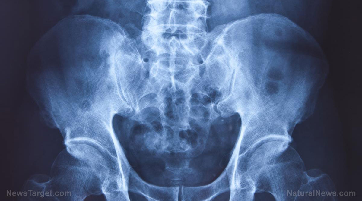 Image: Cobalt in hip replacement parts found to cause Alzheimer’s disease via heavy metals poisoning