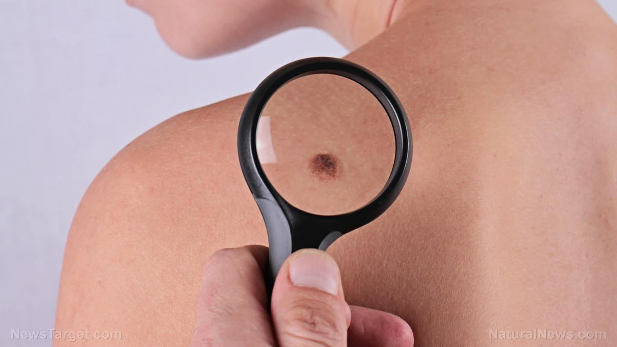 Image: Do your moles put you at risk of melanoma? Find out through ABCDE