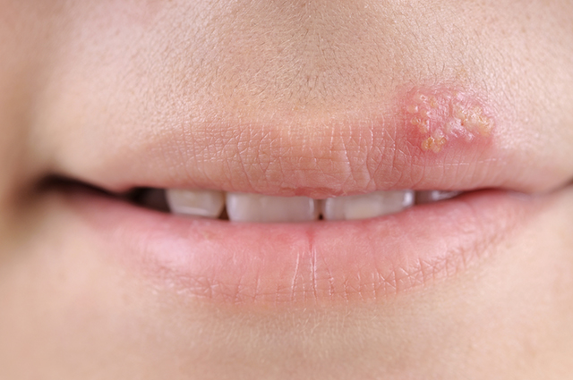 Image: A guide to preventing and treating cold sores using home remedies