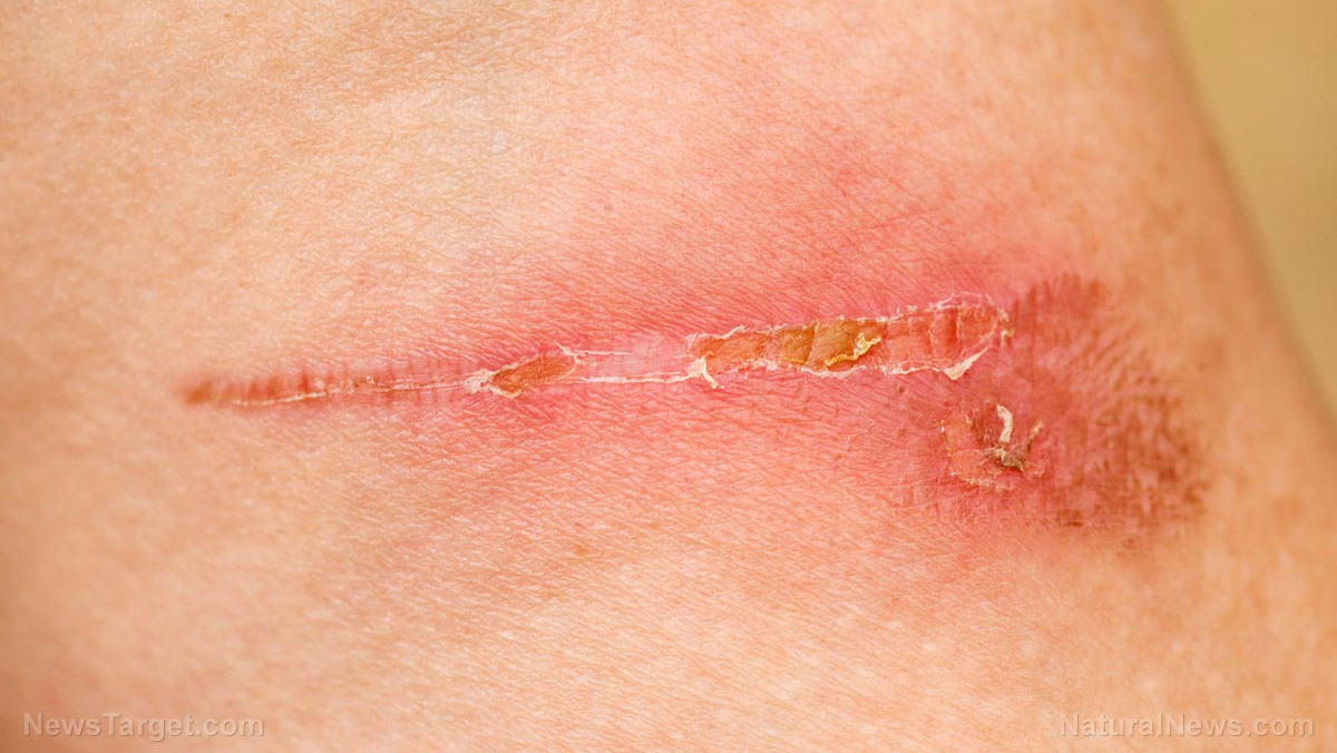Image: New research shows the skin “remembers” injuries, which helps it heal faster the next time