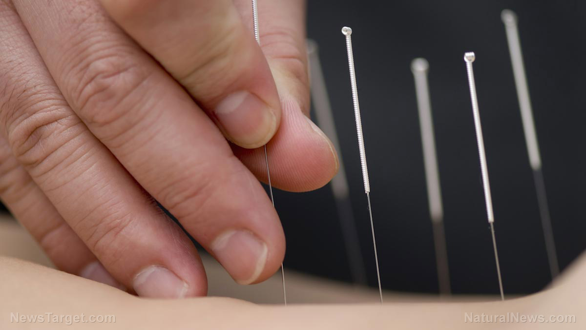 Image: Acupuncture can prevent and treat hypertension in middle-aged people