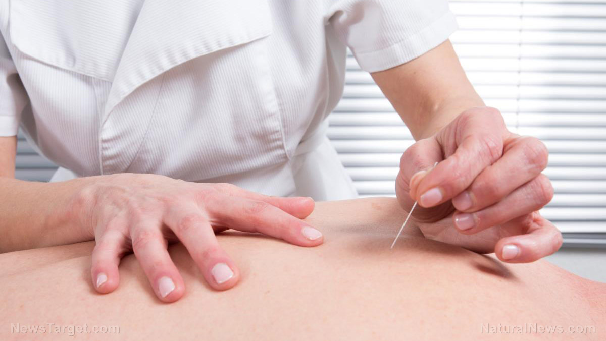 Image: Constipation can be treated with acupuncture