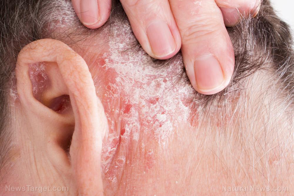 Image: Acupuncture found to be an effective therapy for psoriasis