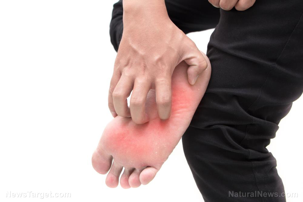 Image: 7 home remedies that may help treat athlete’s foot