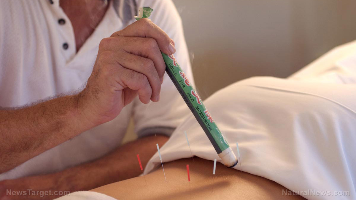Image: Acupuncture helps alleviate menopausal symptoms
