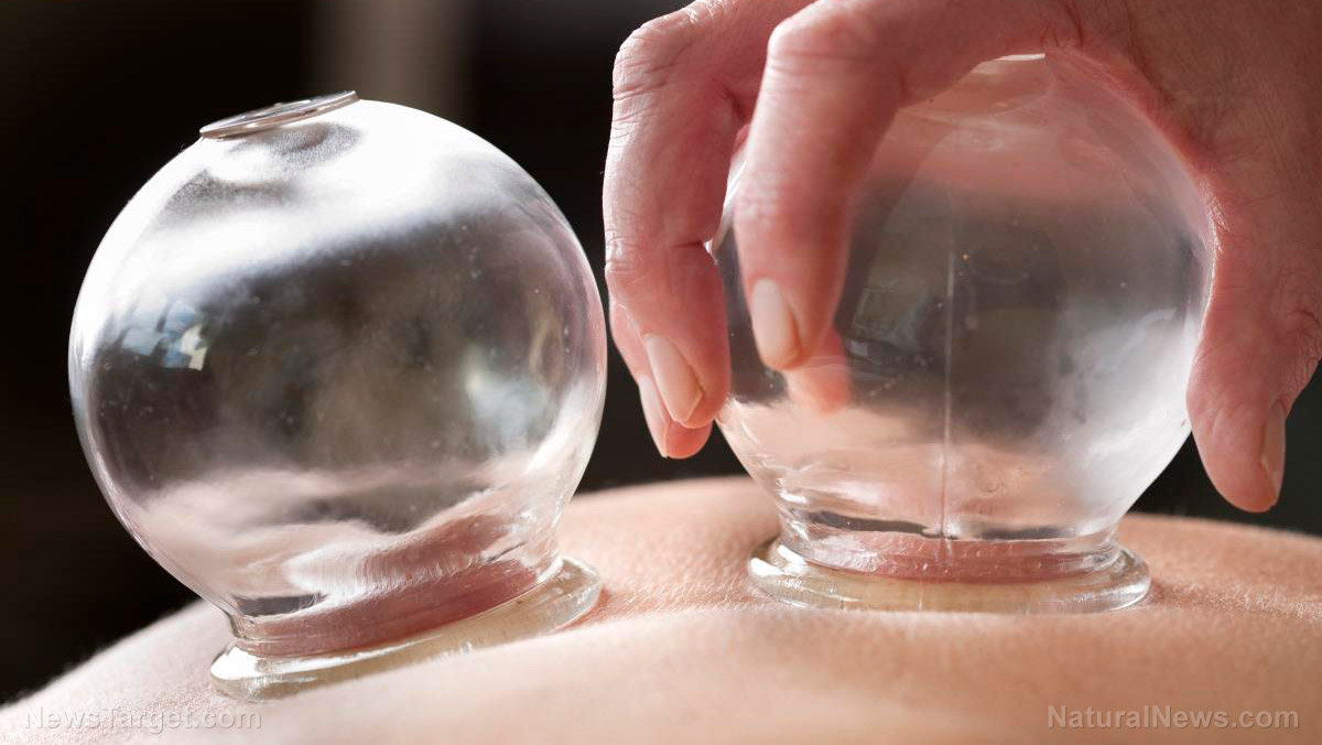 Image: Can dry cupping relieve chronic lower back pain?