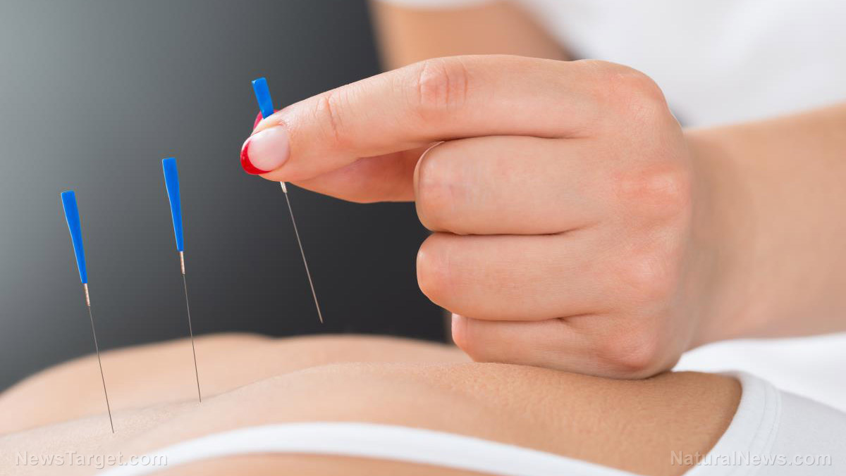 Image: The science is in: Acupuncture can help address treatment-resistant depression