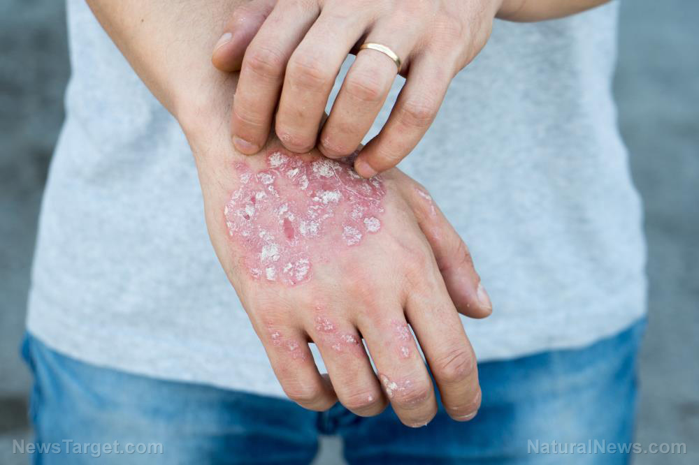 Image: Study: Antibiotics are INEFFECTIVE for eczema