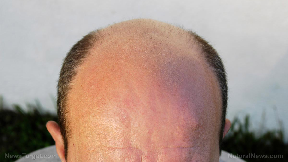 Image: Understanding baldness: Causes, types and potential home remedies
