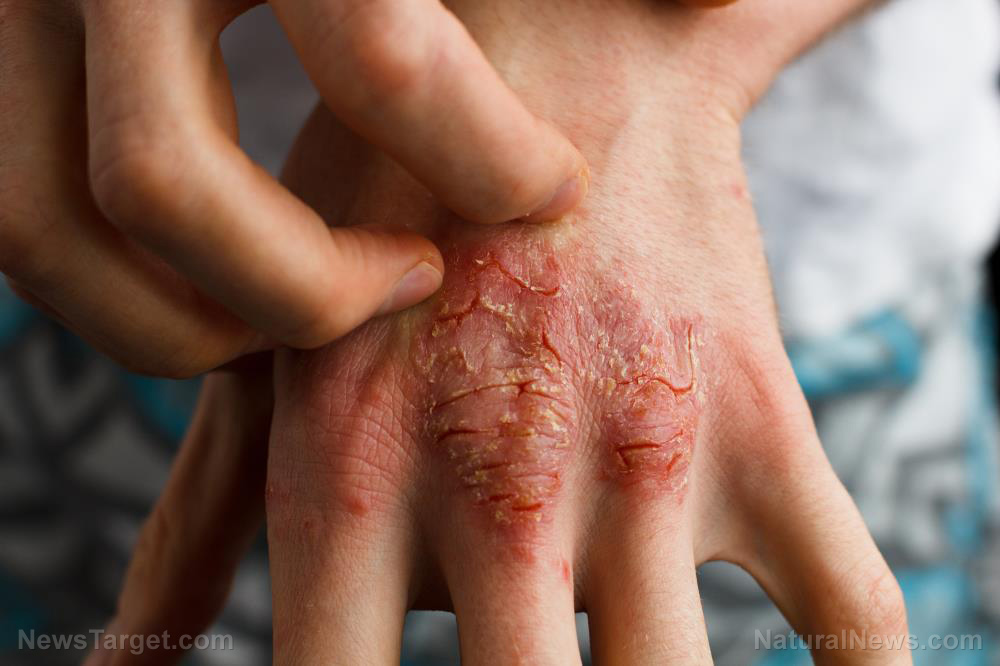 Image: Study reveals surprising link between your skin, gut health and food allergies