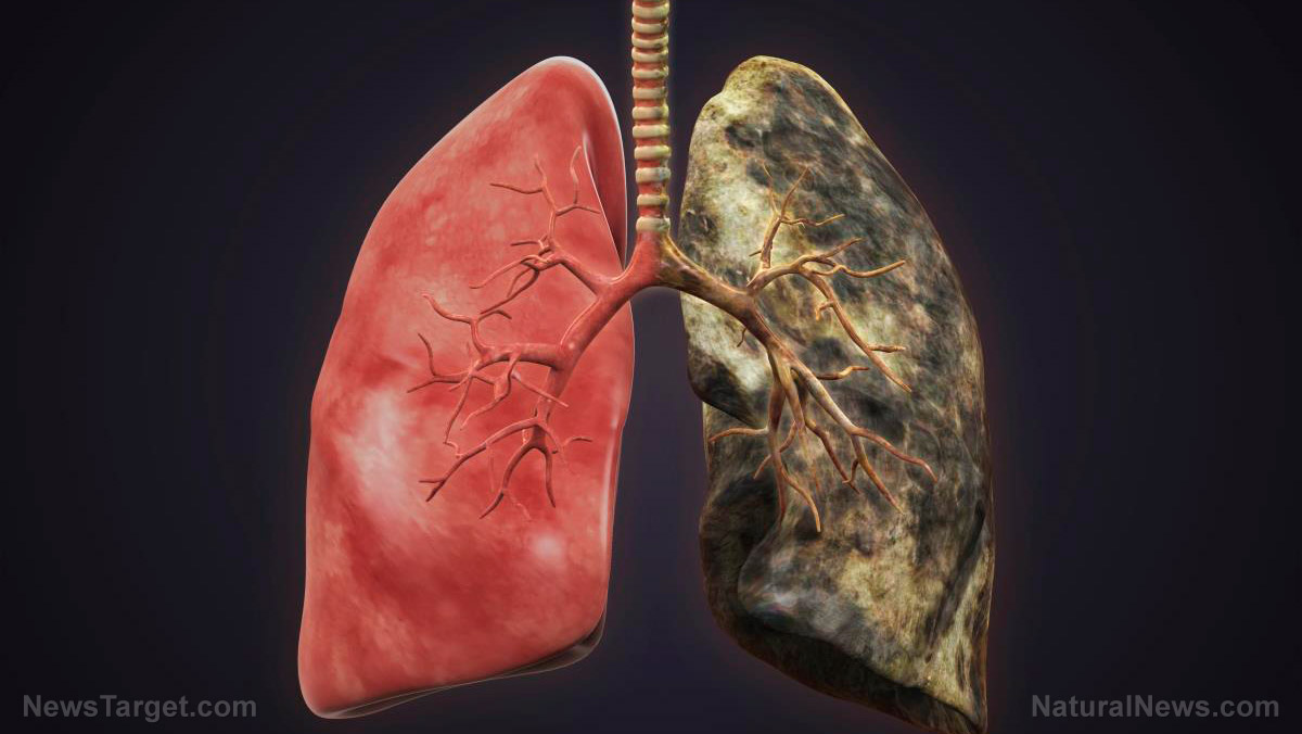 Image: Similarities and differences between emphysema and chronic bronchitis, two conditions that fall under COPD