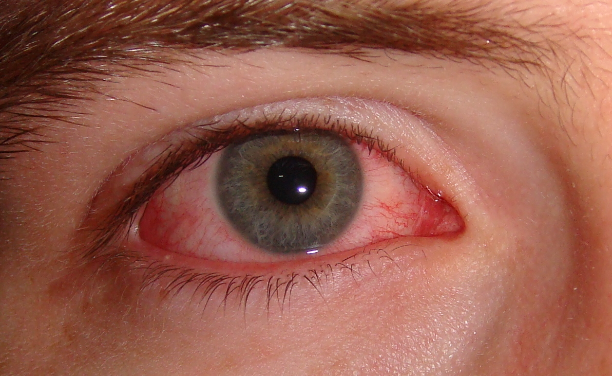 Image: Viral pink eye seen in both symptomatic and asymptomatic coronavirus cases, making it a possible sign of infection