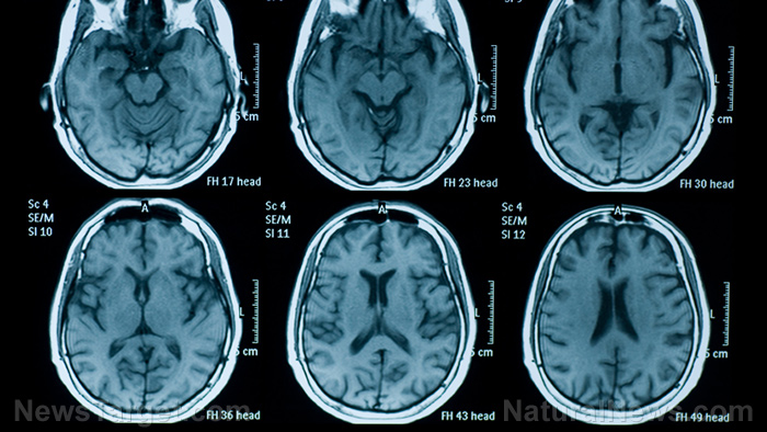 Image: Coronavirus vaccine trial subjects report extreme exhaustion, shortness of breath, day-long headaches and shaking so violently that one of them cracked a tooth