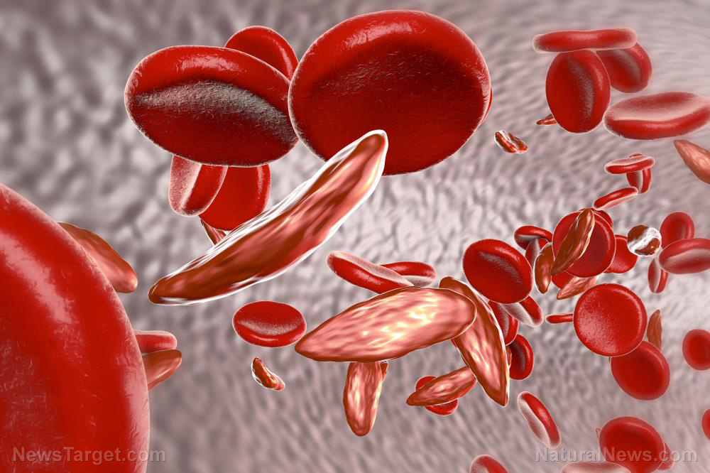 Image: MEDICAL BOMBSHELL: Blood doctor releases findings showing Moderna’s mRNA Covid vaccines change red blood cells from round to tubular, causing them to stick together