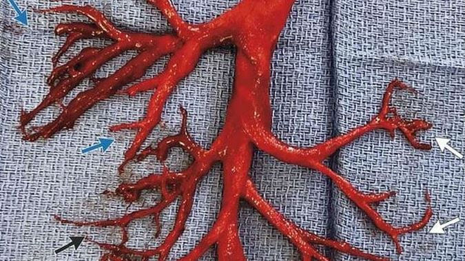 Immagine: Avvertimento sul coagulo: ecco come appare un coagulo di sangue quando il sangue LIQUIDO si trasforma in una massa semisolida gelatinosa all'interno del tuo corpo