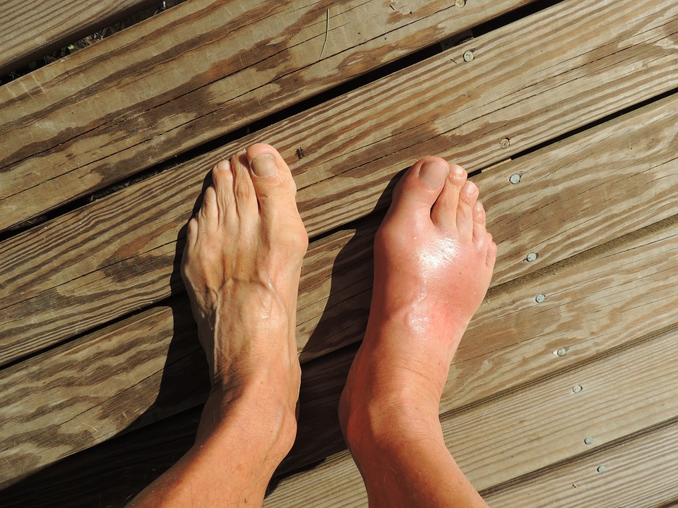 Image: Get natural relief from gout with these 10 home remedies