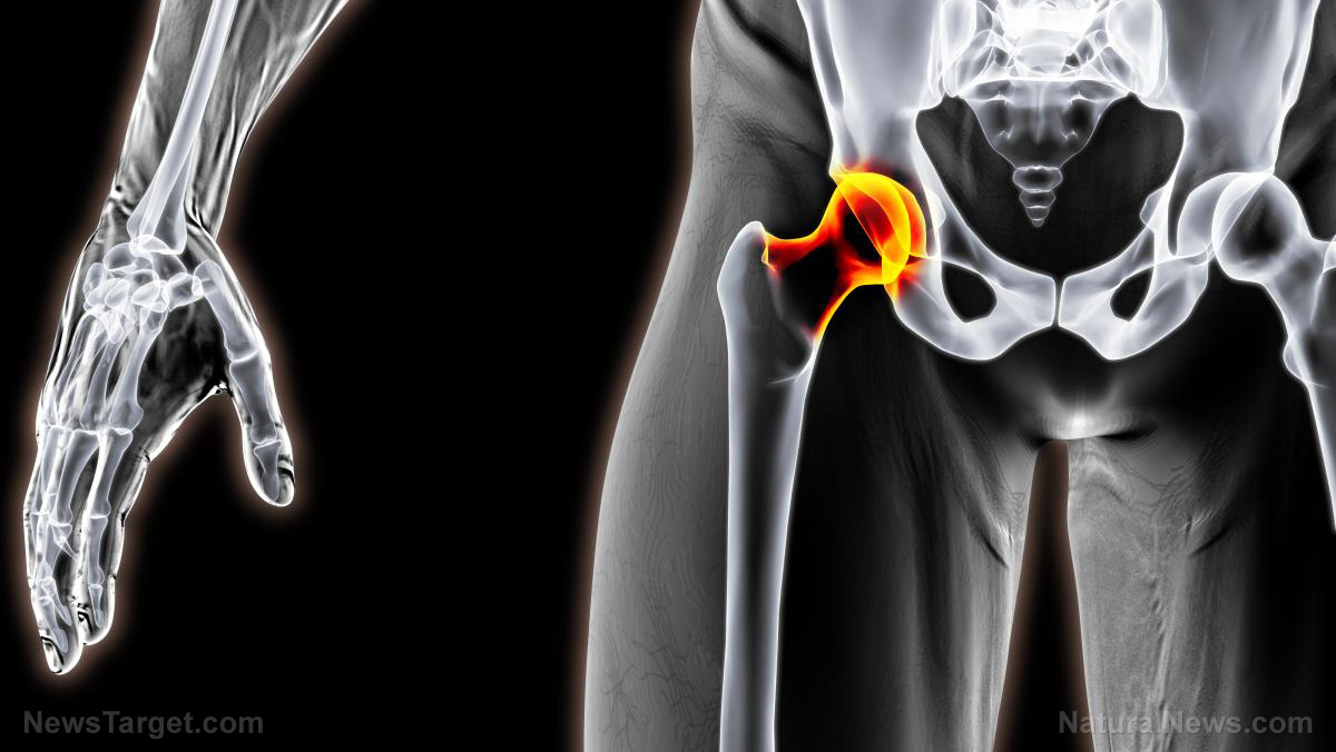 Image: Dietary niacin intake affects risk of hip fracture, hip bone mineral density