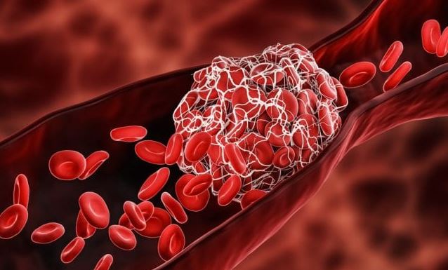 Dr. Jane Ruby: Zwei neue verblüffende Entdeckungen in Blutgerinnseln von COVID-Geimpften