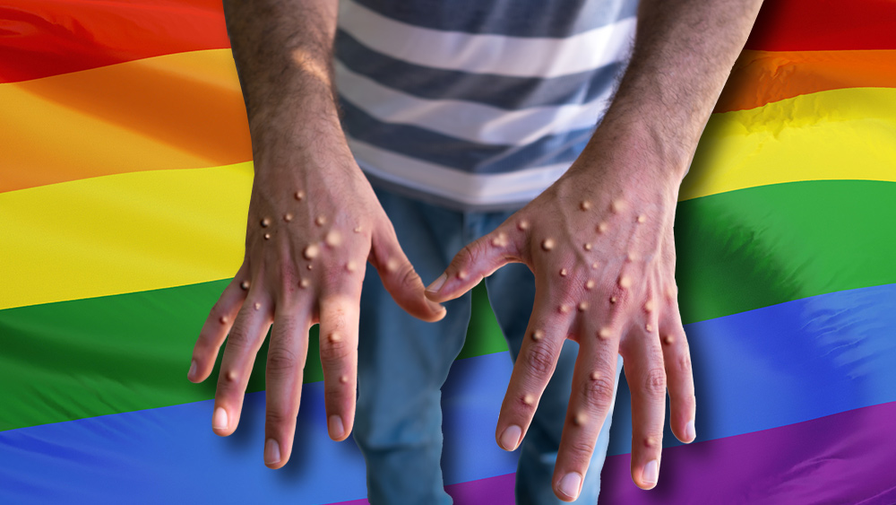 Monkeypox est une maladie gay transmise par le liquide séminal, pas simplement par contact avec la peau, selon une étude