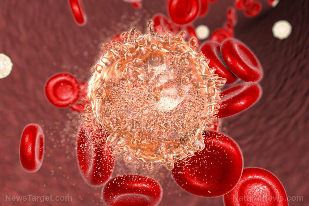 Leukemia Cancer Blood Treatment Cell Hematology Leukaemia