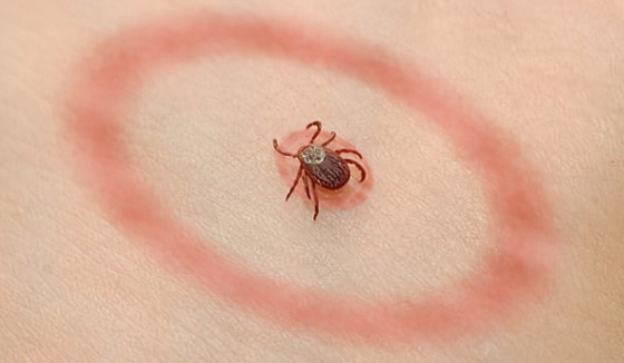 Lyme disease’s staggering financial toll exposed in new study